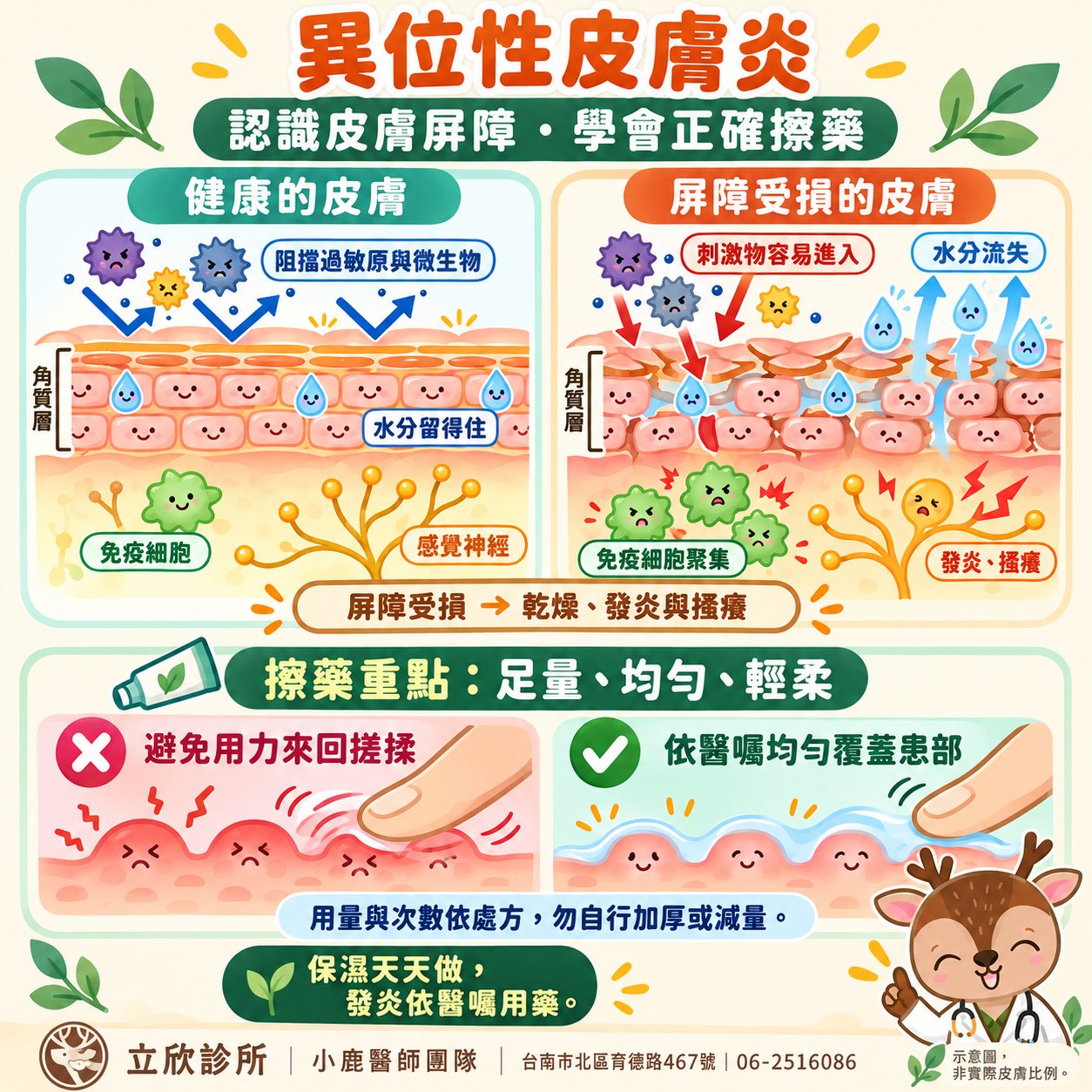 異位性皮膚炎：認識皮膚屏障、學會正確擦藥。健康的皮膚角質層排列緊密，能阻擋過敏原與微生物、水分留得住；屏障受損的皮膚刺激物容易進入、水分流失，免疫細胞聚集，引起發炎與搔癢。擦藥重點是足量、均勻、輕柔：避免用力來回搓揉，依醫囑均勻覆蓋患部；用量與次數依處方，勿自行加厚或減量。保濕天天做，發炎依醫囑用藥。示意圖，非實際皮膚比例。